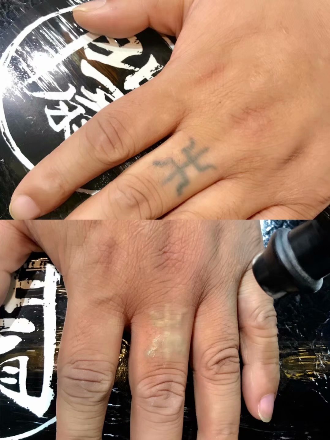 皮秒洗纹身「一扇门供」