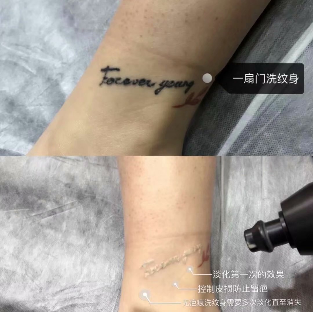 皮秒洗纹身「一扇门供」 - 天长网