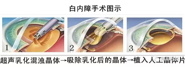 白内障手术前注意事项